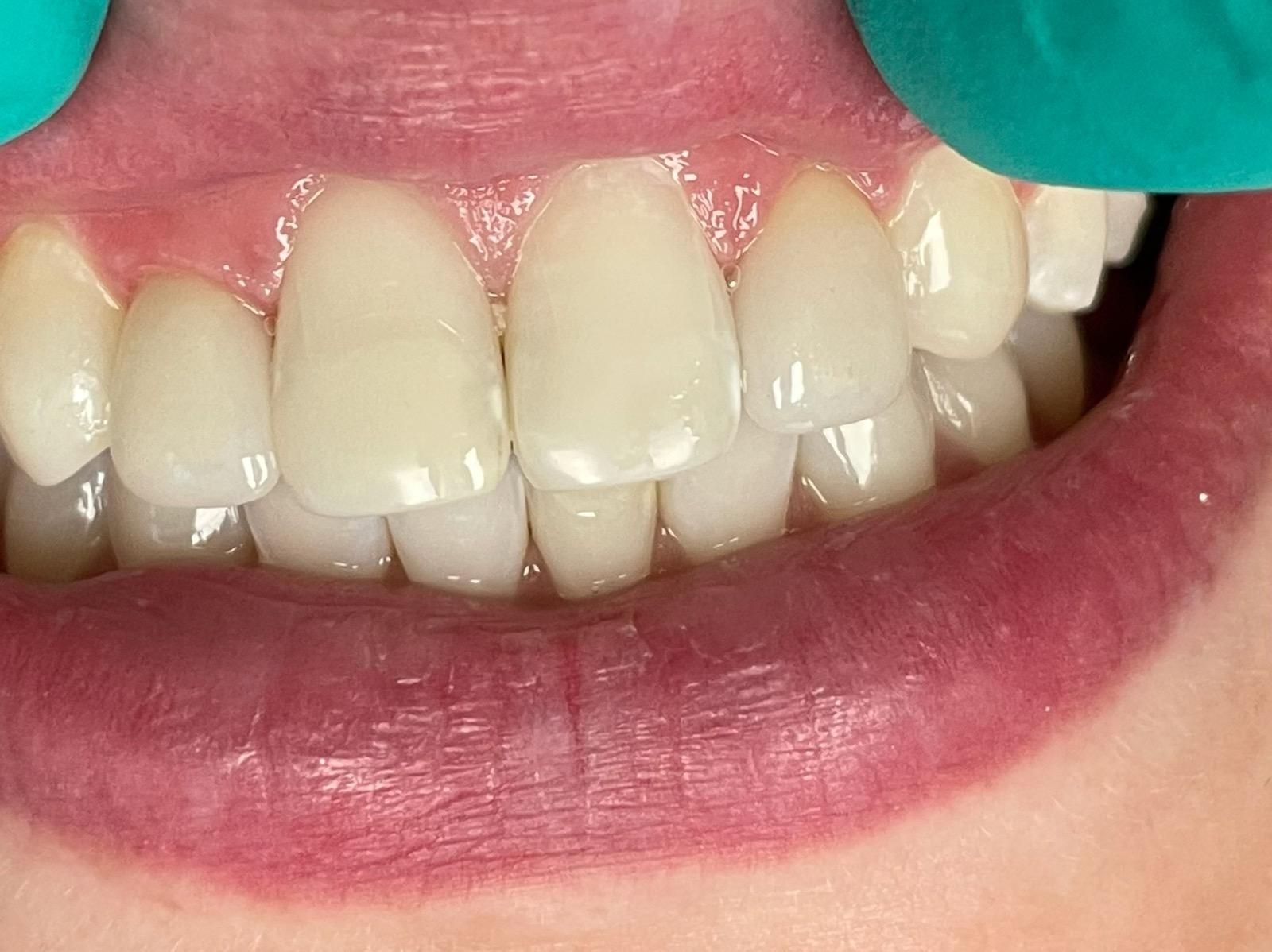 Implant Supported Crowns