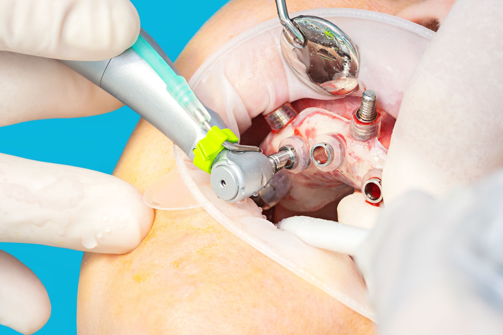 Close up of digital guided implant surgery on patient - new implant technology in dentistry.